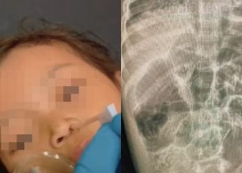 Balita di Sukabumi Meninggal, Tubuh Penuh Cacing: Alarm Kesehatan Masyarakat