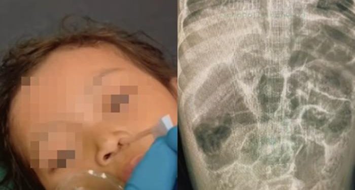 Balita di Sukabumi Meninggal, Tubuh Penuh Cacing: Alarm Kesehatan Masyarakat